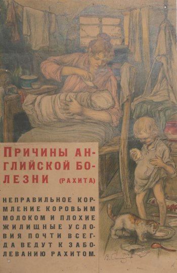 Изображена сидящая женщина кормящая из рожка ребенка. Рядом стоит другой ребенок с большой головой, животом и кривыми ногами. Слева внизу текст: Неправильное... рахитом